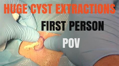 Sandra Lee removed a cyst from a patient's cheek in her latest YouTube video. . Large cyst removal videos 2022